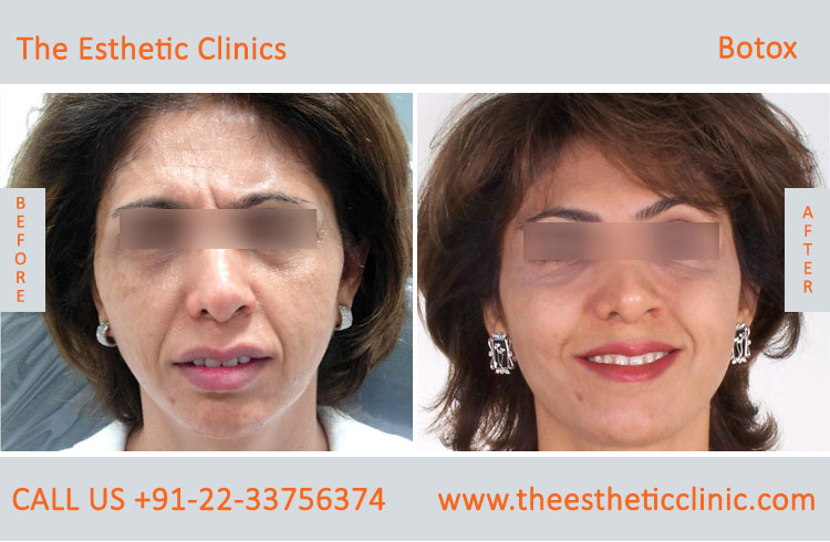 botox treatment for face wrinkles before after photos in mumbai india (8)